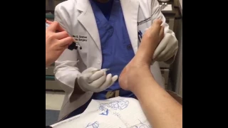 Dr Shaheed Plantar Fasciitis Injections  Dr Shaheed Plantar Fasciitis Injections