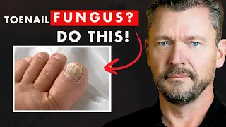 CURE Toenail Fungus And Keep It Gone FOREVER 