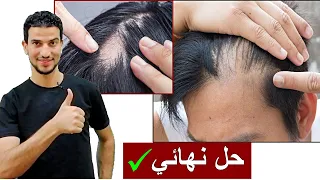 حل سريع لتراجع الشعر للخلف فراغات الشعر وعلاج الثعلبة في ايام 