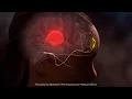How Nurtec ODT Can Help With Crippling Migraines