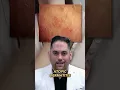 Can you tell if it s eczema or psoriasis