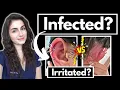 Doctor explains Is your piercing infected How to care for a new cartilage piercing