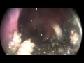 Download Lagu Nasal Myiasis | NEJM
