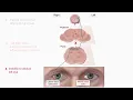 Lagu internuclear ophthalmoplegia