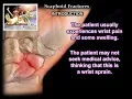 Download Lagu Scaphoid Fractures - Everything You Need To Know - Dr. Nabil Ebraheim