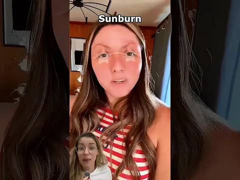 Quemadura solar #sunburn