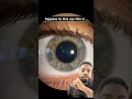 Nystagmus