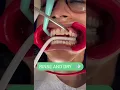 The Process of Getting my Spark Aligners