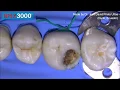 Caries removal with Brix 3000 enzymatic gel.