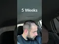Hair Transplant Process - Week by Week