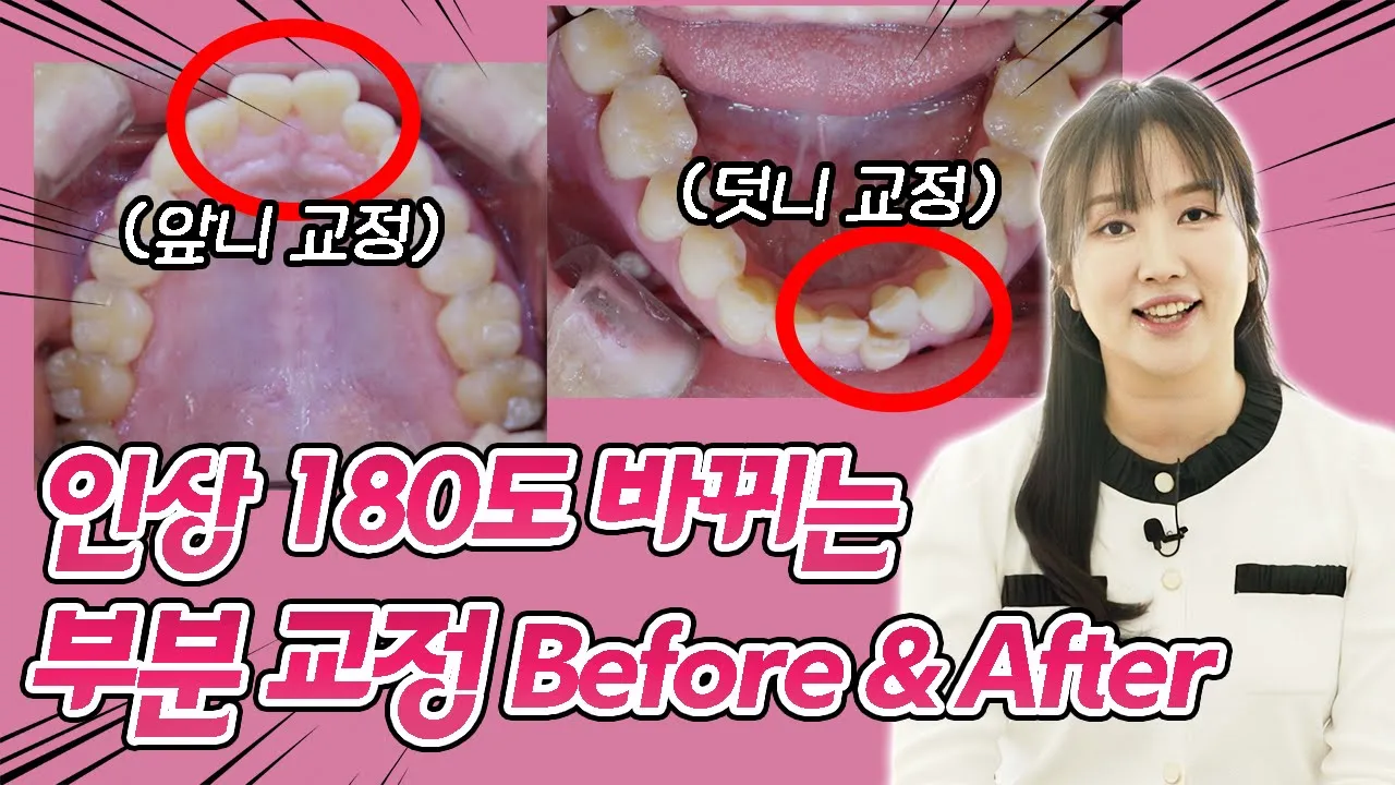 부분 교정, 앞니 교정, 설측 교정으로 짧은 기간 안에 치아 콤플렉스 100% 해결 가능! I 스마일뷰치과 러블리 김원장