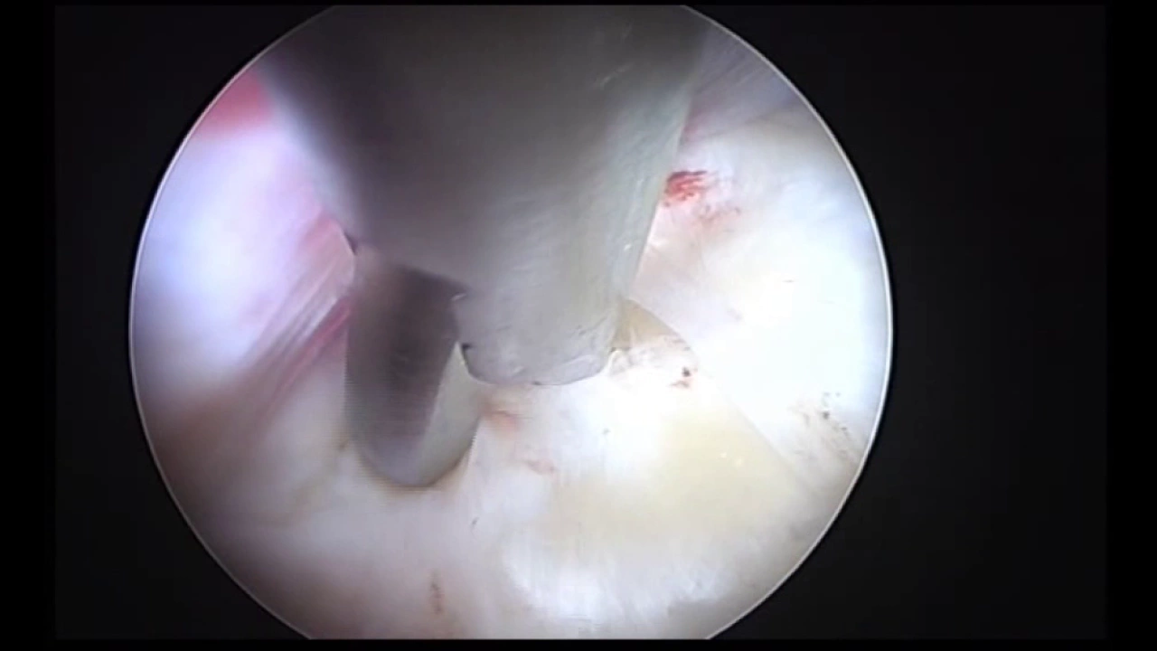 This video talks about Hernia Nucleus Pulposus (HNP). 