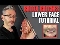 Download Lagu ADVANCED BOTOX ANATOMY: How to avoid nasty lower-face side effects [Aesthetics Mastery Show] MP3