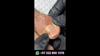 esta uña se deformo por un golpe... que no te pase a ti