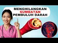 Cara Menghilangkan Sumbatan Plak di Pembuluh Darah Tanpa Operasi
