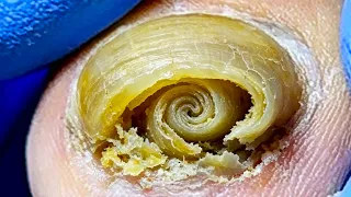Toenails Are Like Shells, Hiding Impurities~【Xue Yidao】