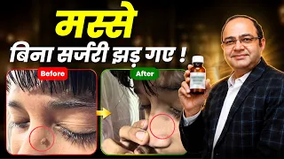 सिर और नाक के मस्से (Warts) जड़ से खत्म | Best Homeopathy Treatment for Warts | Real Case Study