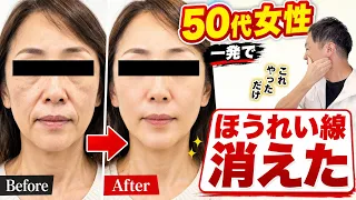 【ほうれい線・ブルドッグ顔解消】50代女性のほうれい線・顔のたるみ・マリオネットラインが一瞬で消えたマッサージ1回やってみて！