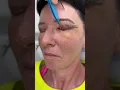 Download Lagu Control la 7 zile după operația de Lifting a pleoapelor [#blefaroplastie superioară] la Doctor Levy