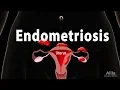 Endometriosis Pathology Symptoms Risk factors Diagnosis and Treatment Animation