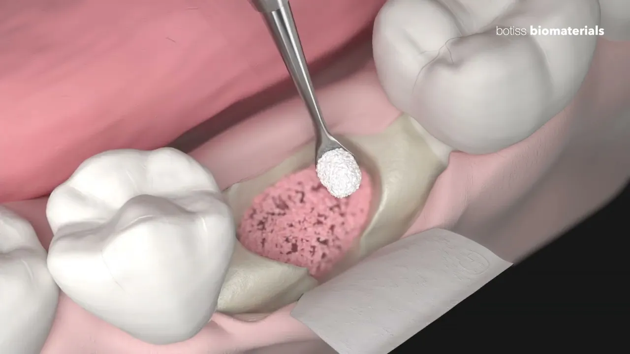 botiss ridge preservation animation