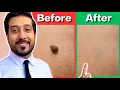 How to Remove Skin Tags Yourself AT HOME Get Rid of Skin Tags NOW
