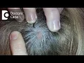 What does small skin colored lump on the scalp indicate - Dr Urmila Nischal