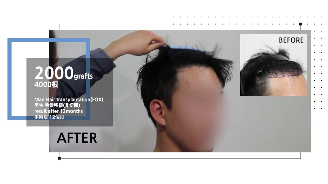 Man hair transplantation results after 12months - 뉴헤어 I 모발이식 I Before&After I