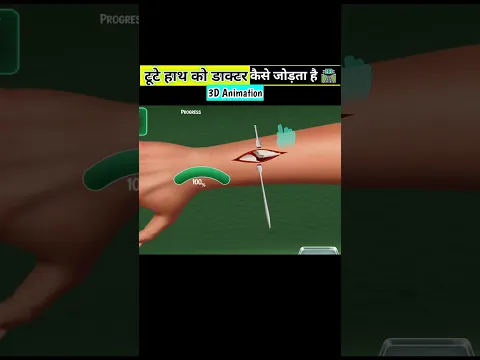 टूटे हाथ को डाक्टर कैसे जोड़ता है l how does a doctor fix a broken arm l #shorts @BrainzFacts