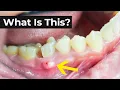 What is an Abscessed Tooth What To Do About It
