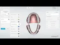 Fully Digital All-on-X Dental Implant Workflow H-Cap Multiunit EZ Scanbody Exocad design