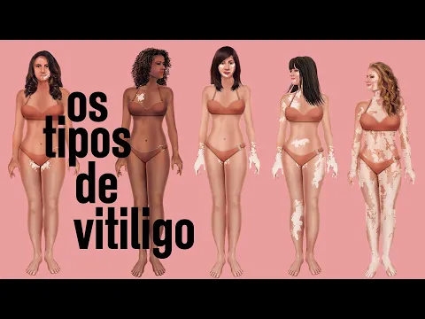 Download MP3 Os tipos de vitiligo que existem