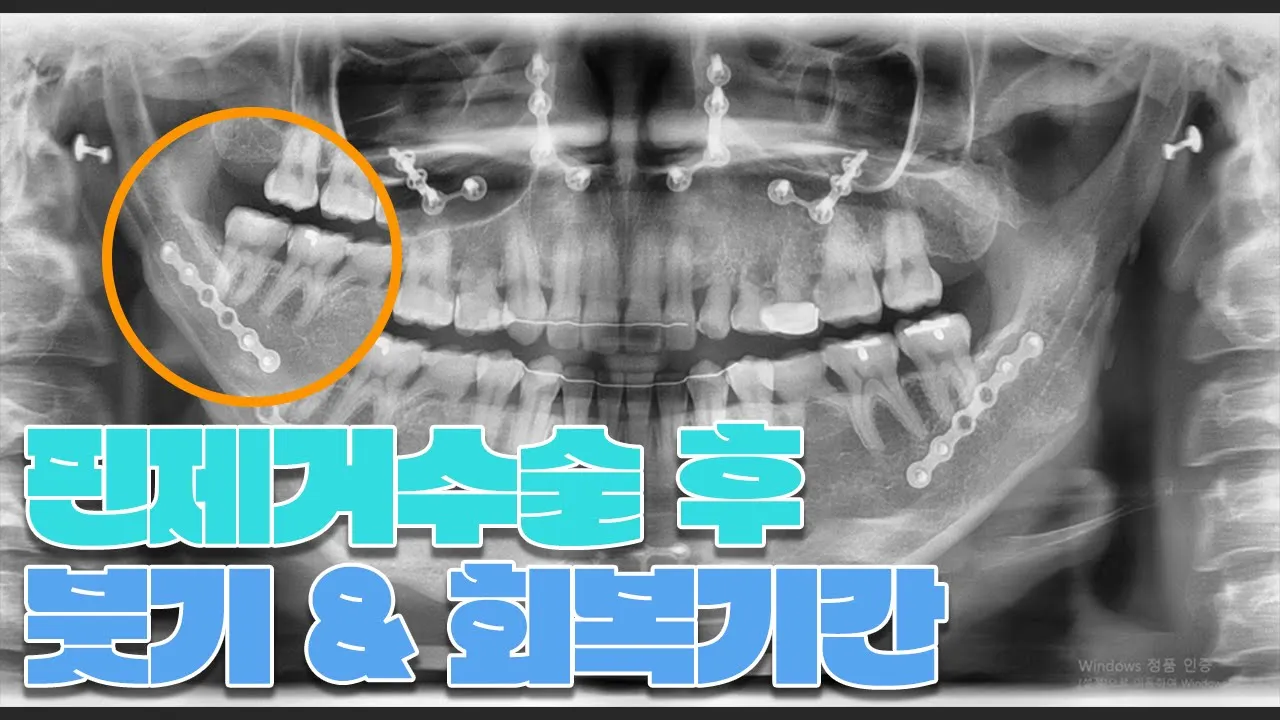 양악 & 안면윤곽 핀제거 수술 필요성? 붓기? 회복기간?