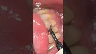 تنظيف وإزالة جير الاسنان المتراكم 