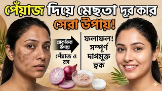 পেঁয়াজ দিয়ে কঠিন মেছতার দাগ দূর হবে চিরতরে/ Reduce Melasma, pigmentation, discoloration, blackspots