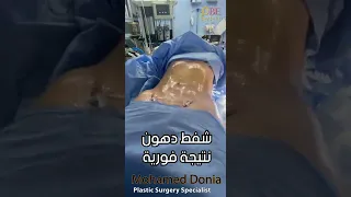 اسرع طريقة للتخسيس شفط دهون البطن دكتور محمد دنيا دكتور تجميل تنسق قوام شفط دهون جسم مثالي 