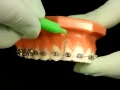 Bracesquestions com - Brushing With Braces How to Brush Teeth
