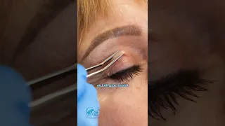 عملية شد الجفون د محمد فاروق المغربي 