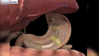 به م رێگا ئاسانه كۆتایی به غازاتی ناو سك بهێنه 