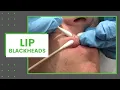 Lip Blackheads Dr Derm