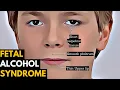 Fetal Alcohol Syndrome Causes Signs and Symptoms Diagnosis and Treatment
