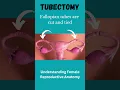 Download Lagu Tubectomy Procedure: A Safe Method for Permanent Contraception #fallopiantubes #shorts