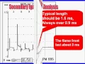 3 Secondary Ignition Scope Pattern Analysis