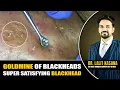 GOLDMINE OF BLACKHEADS II SUPER SATISFYING BLACKHEAD REMOVAL BY DR LALIT KASANA