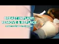 Breast Implant Removal Replacement What You Need to Know Dr Rahal Explains LIVE surgery