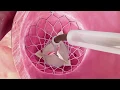 Walker Heart Institute - Dr Joel Carver