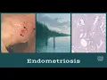 Endometriosis - pathology distribution pathogenesis