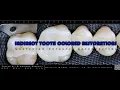 INDIRECT TOOTH COLORED RESTORATIONS - 2022