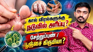 கால் அரிப்பு ஏன் வருகிறது? Fungal Infection-ஐ எப்படி கண்டுபிடிப்பது?”#Athlets_Foot_Treatment #drsj