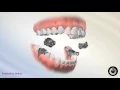 Missing Teeth and Braces